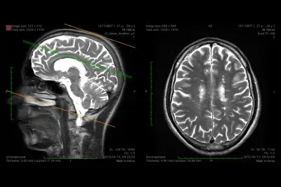 Black and white MRI scans of a human head in both profile and aerial view.